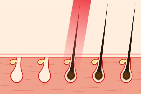 Download Hair Removal with Laser Light Vector - Laser light Collection